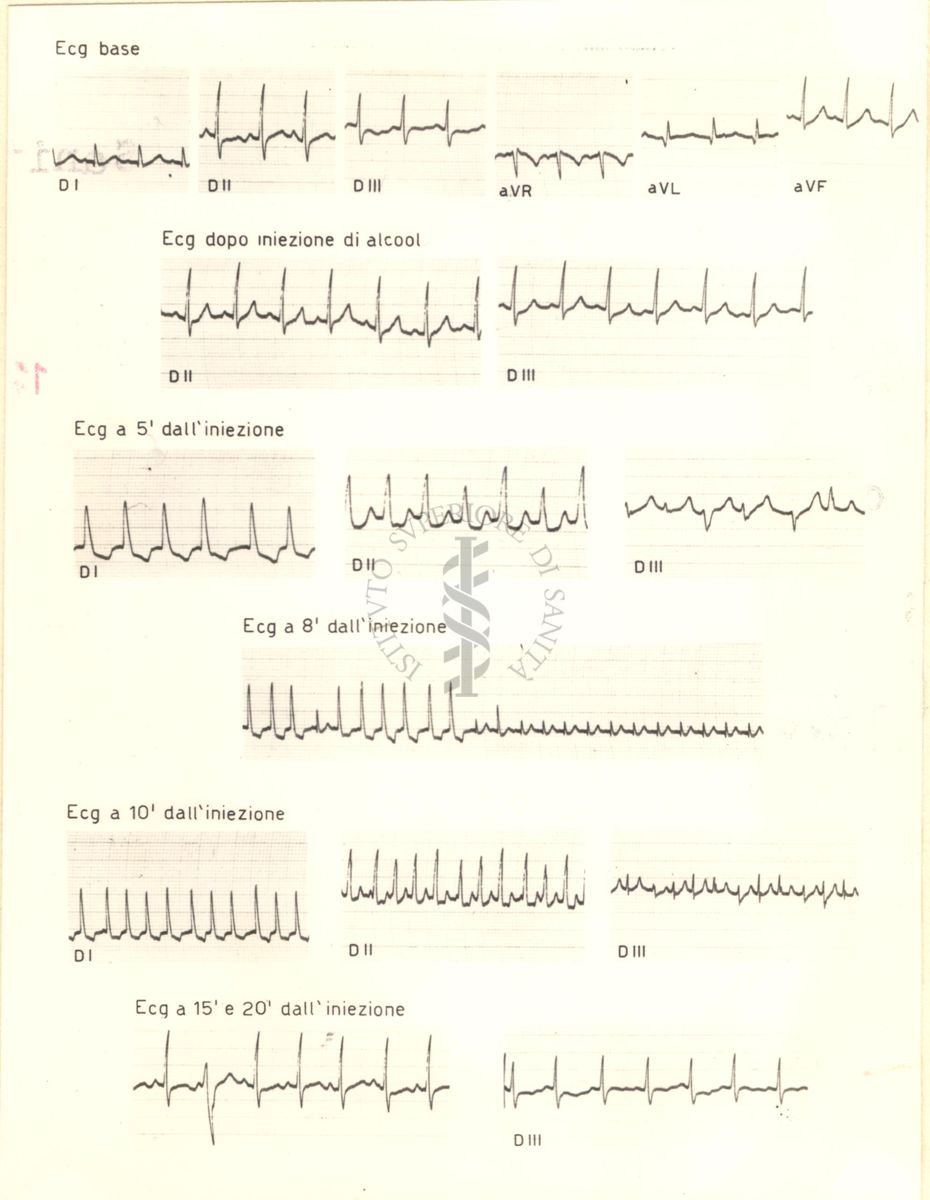 Tracciati di elettrocardiogramma che mostrano l'azione dell'alcol etilico sul cuore di coniglio, 5, 8, 10, 15 e 20 minuti dopo l'iniezione