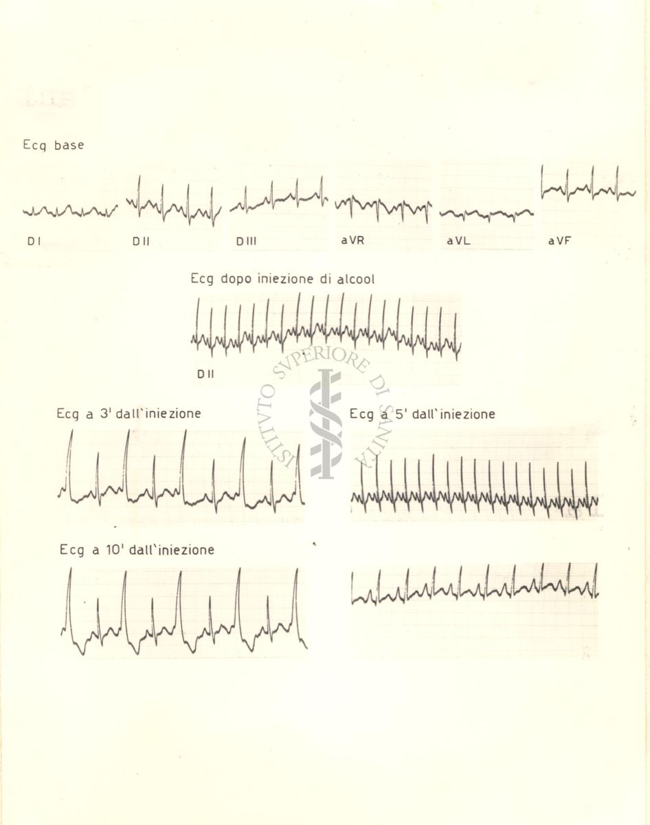 Tracciati di elettrocardiogramma che mostrano l'azione dell'alcol etilico sul cuore di coniglio, 3, 5 e 10 minuti dopo l'iniezione