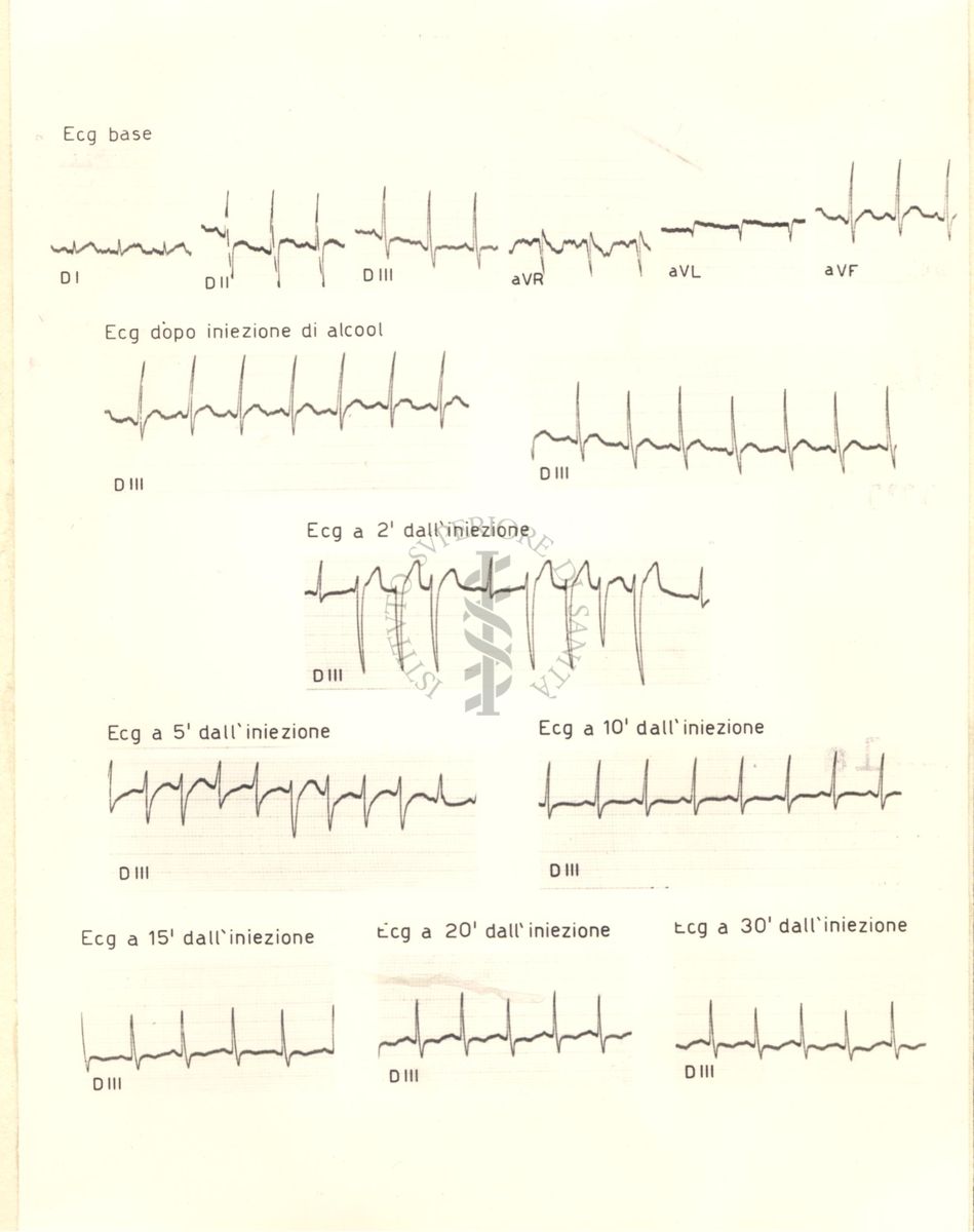 Tracciati di elettrocardiogramma che mostrano l'azione dell'alcol etilico sul cuore di coniglio, 2, 5, 10, 15, 20 e 30 minuti dopo l'iniezione