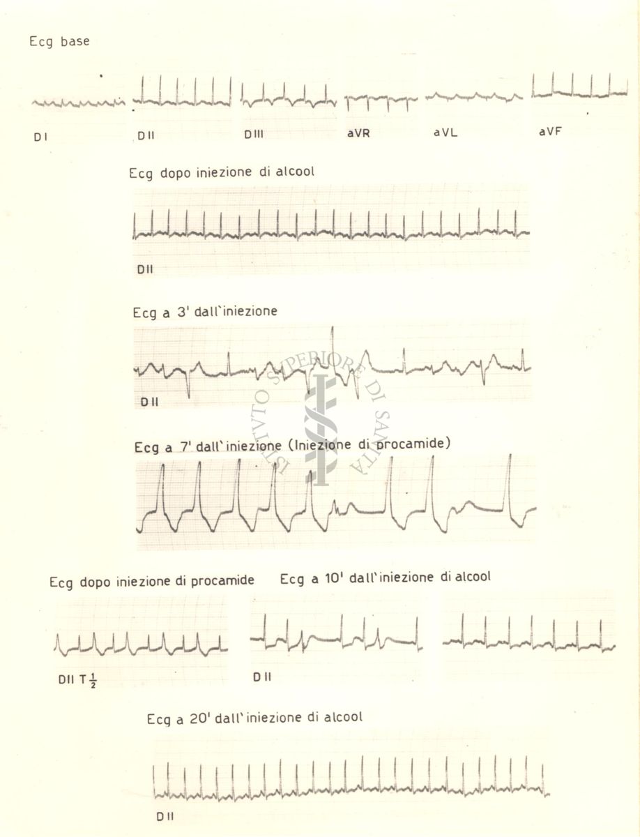 Tracciati elettrocardiografici del cuore di coniglio dopo 3, 10 e 20 minuti dalla somministrazione di alcol e dopo 7 minuti dalla somministrazione di procamide