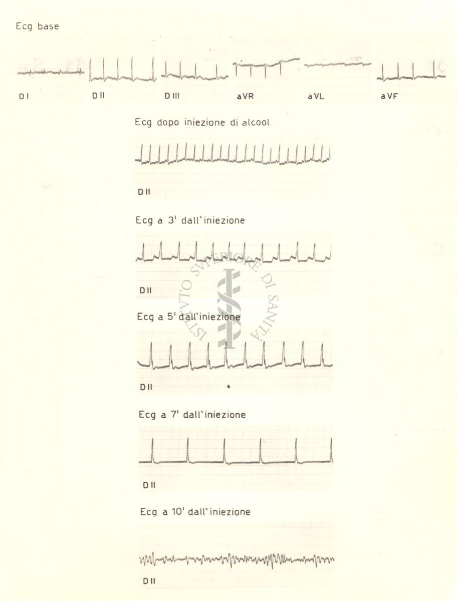 Tracciati elettrocardiografici del cuore di coniglio dopo 3, 5, 7 e 10 e 20 minuti dalla somministrazione di alcol