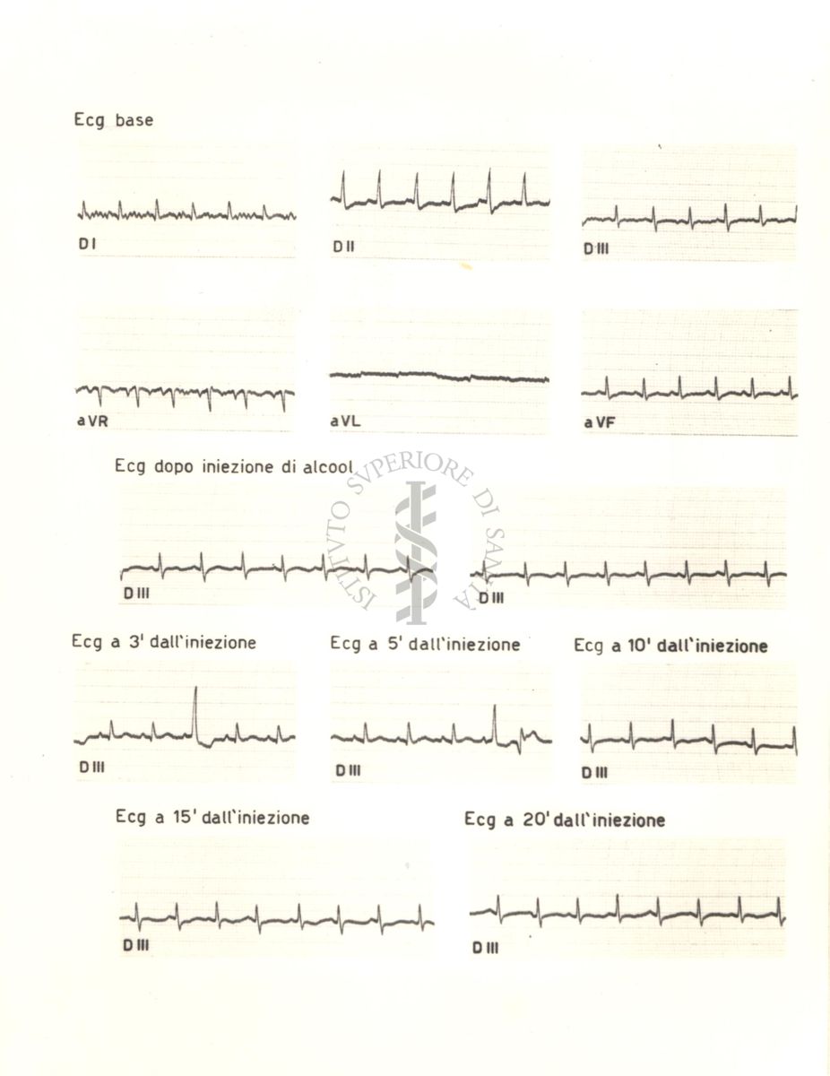 Tracciati elettrocardiografici del cuore di coniglio dopo 3, 5, 10, 15 e 20 minuti dalla somministrazione di alcol