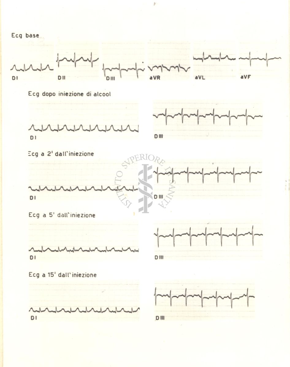 Tracciati elettrocardiografici del cuore di coniglio dopo 2, 5, e 15 minuti dalla somministrazione di alcol