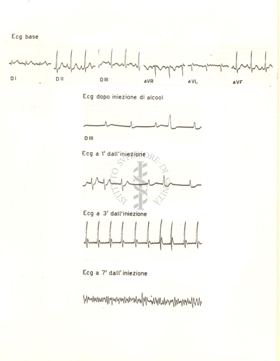 Tracciati elettrocardiografici del cuore di coniglio dopo 1, 3, e 7 minuti dalla somministrazione di alcol