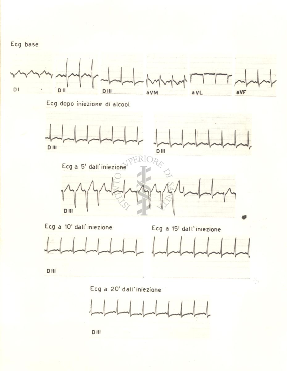 Tracciati elettrocardiografici del cuore di coniglio dopo 5, 10, 15 e 20 minuti dalla somministrazione di alcol