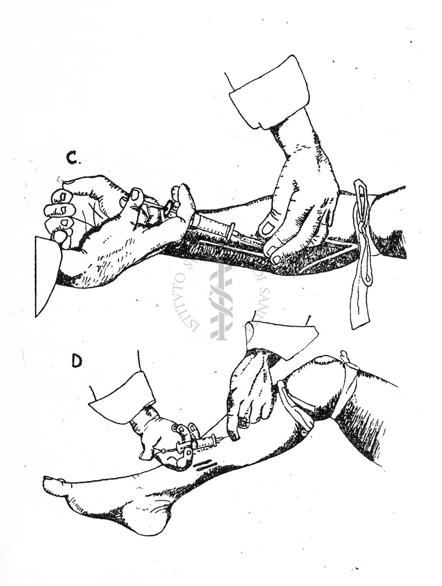 Tecnica di iniezione locale antiofidica C) avambraccio - D) gamba