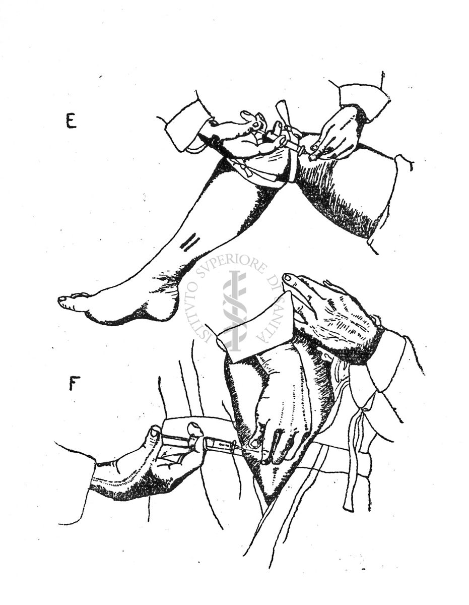 Tecnica di iniezione locale antiofidica E) cosce - F) braccio