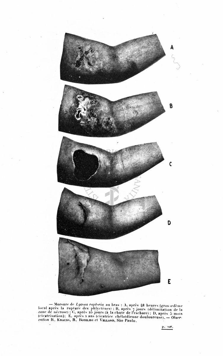 Effetti di morsicatura di una Lycosa raptoria