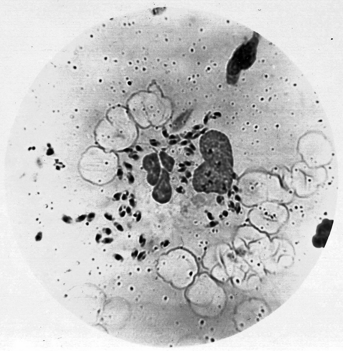 Leishmania tropica nel bottone d'oriente umano (Abruzzi)