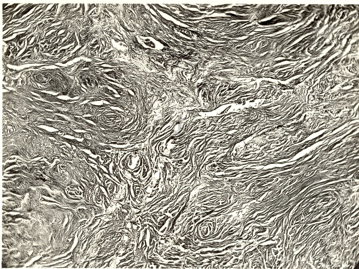 Neurofibroma