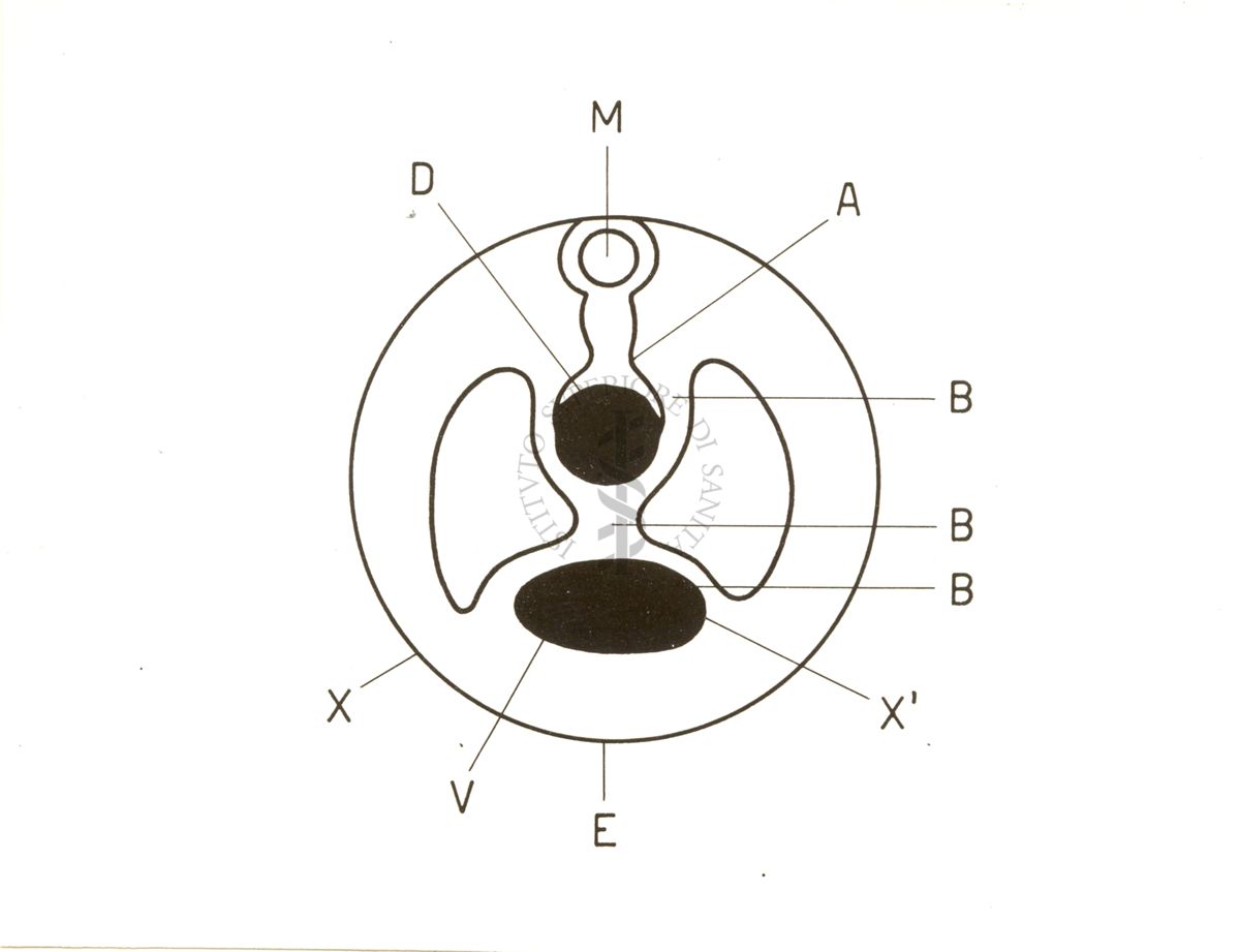 Maltoformazione embrionaria (Estrofia vescicale totale).