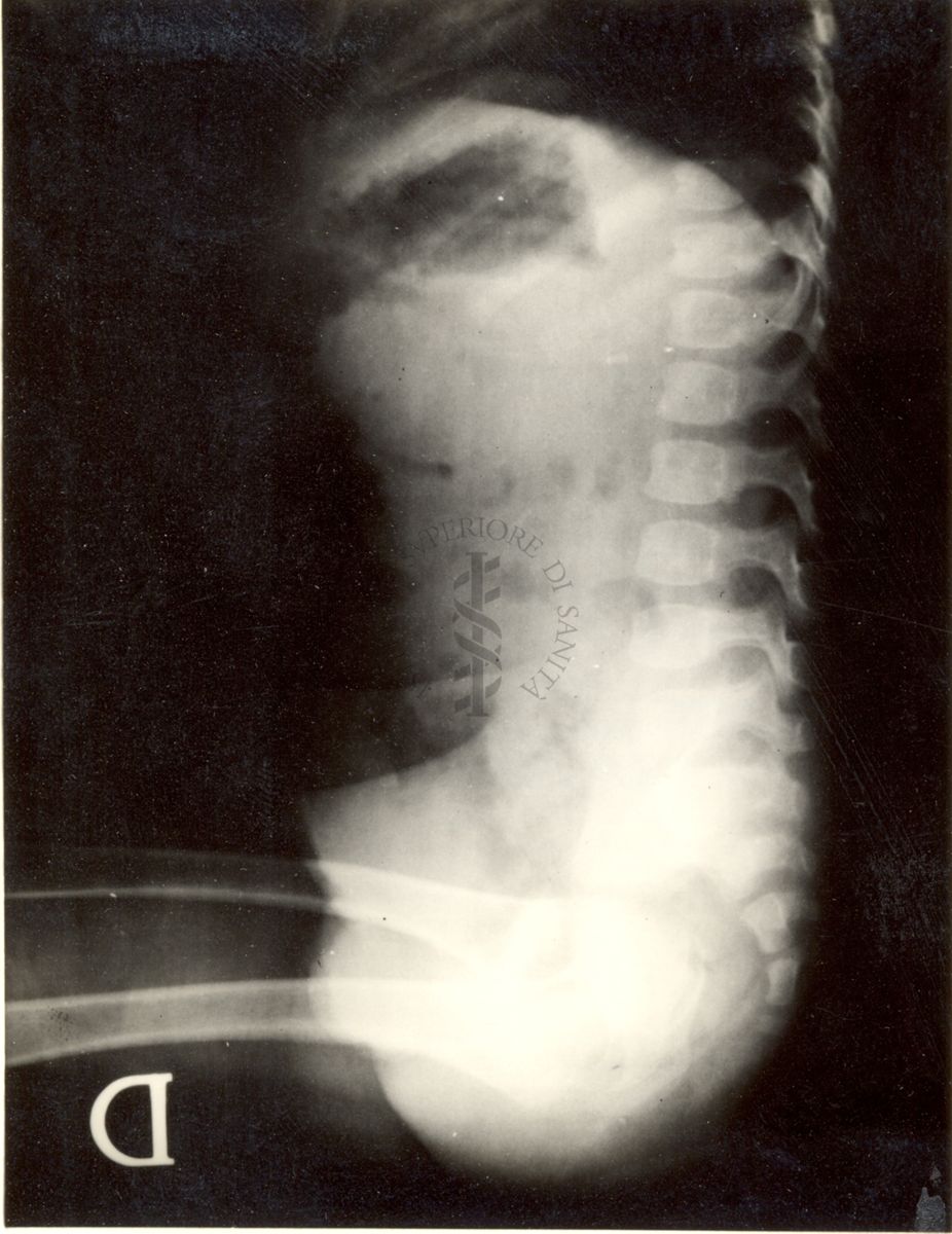 Maltoformazione embrionaria (Estrofia vescicale totale).