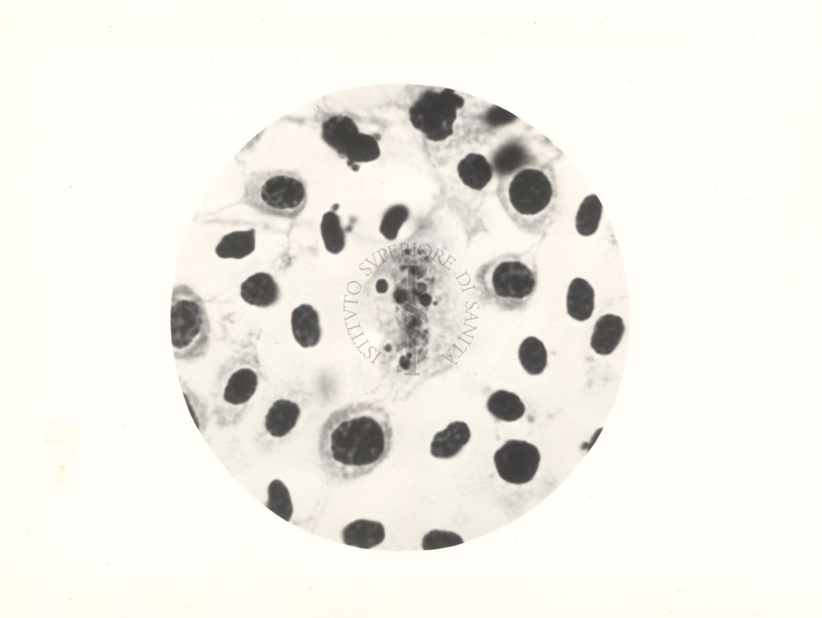 Fagocitosi del pigmento da parte di cellule reticolo endoteliali (midollo osseo) nell'infezione da Plasmodium gallinaceum