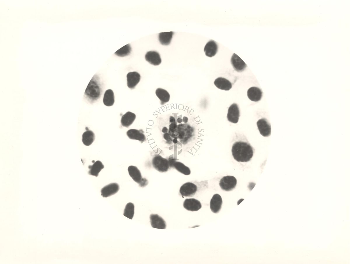 Fagocitosi del pigmento da parte di cellule reticolo endoteliali (midollo osseo) nell'infezione da Plasmodium gallinaceum