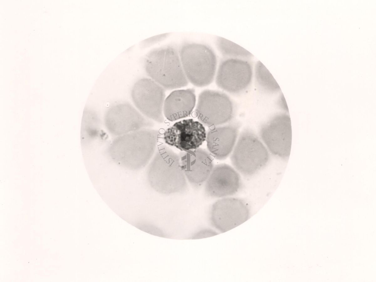 Plasmodium vivax. Trofozoite in globulo rosso con granulazioni di Schuffner