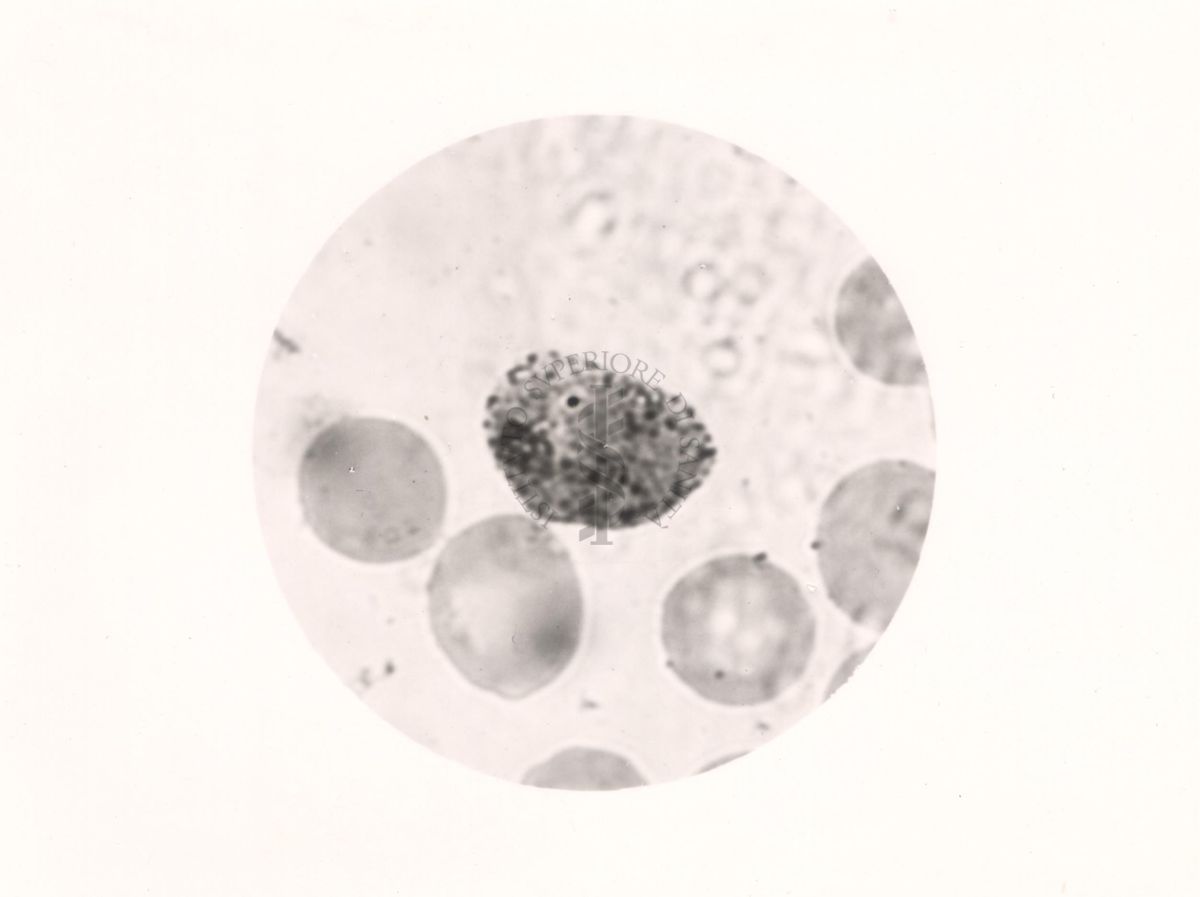 Plasmodium vivax. Trofozoide in globulo rosso con granulazioni di Schuffner