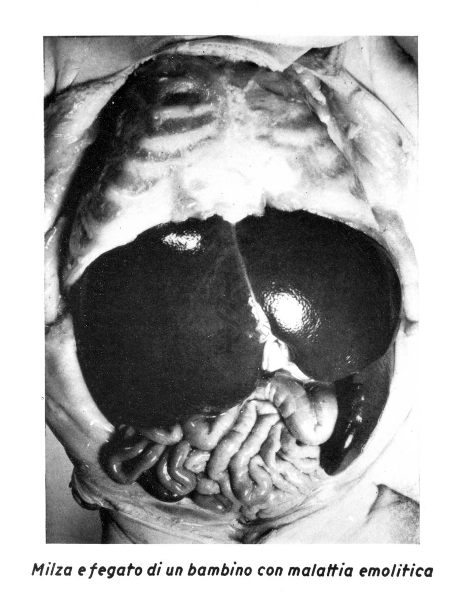 Milza e fegato di un bambino con malattia emolitica