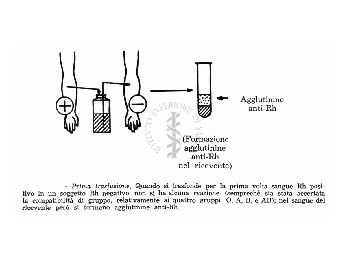 Diagramma dimostrativo della ipoimmunizzazione da R H per trasfusione