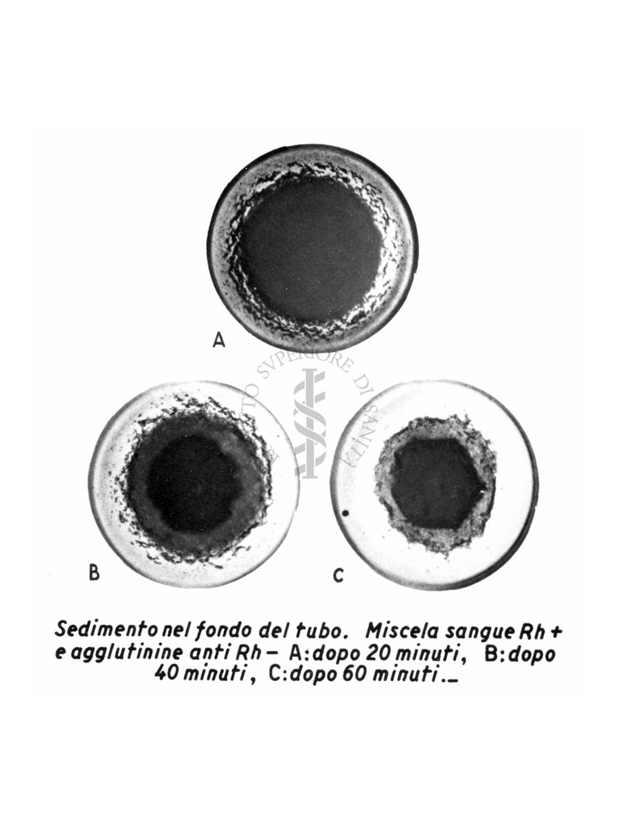 Sedimento nel fondo del tubo. Miscela sangue R H + e agglutinine anti RH - A. dopo 20 minuti. B. dopo 40 minuti C. dopo 60 minuti