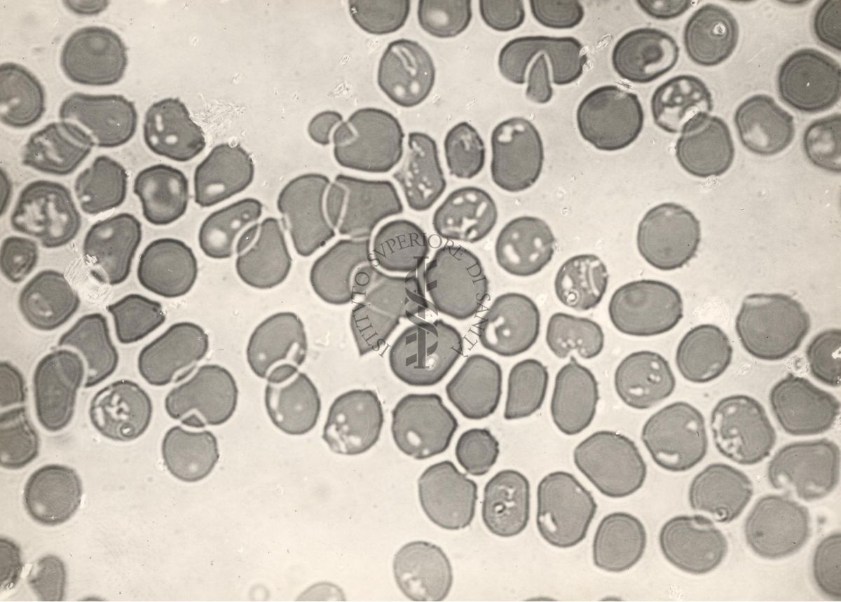 Globuli rossi maculati nella Malaria