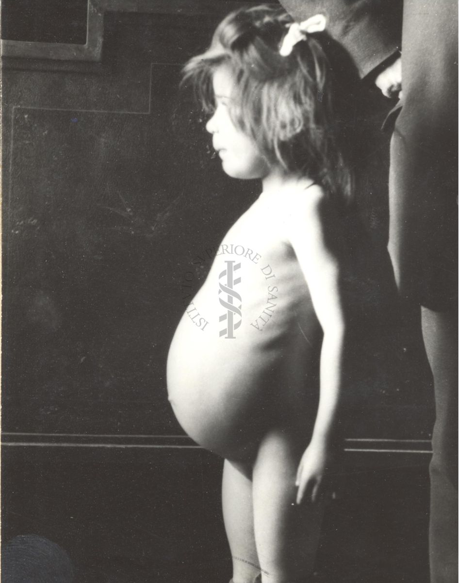 Immagine di bambina affetta da malaria con tumore splenico.