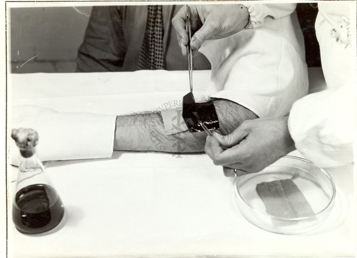 Tecnica di medicatura con Penicillina - c) copertura con guttaperga laminata