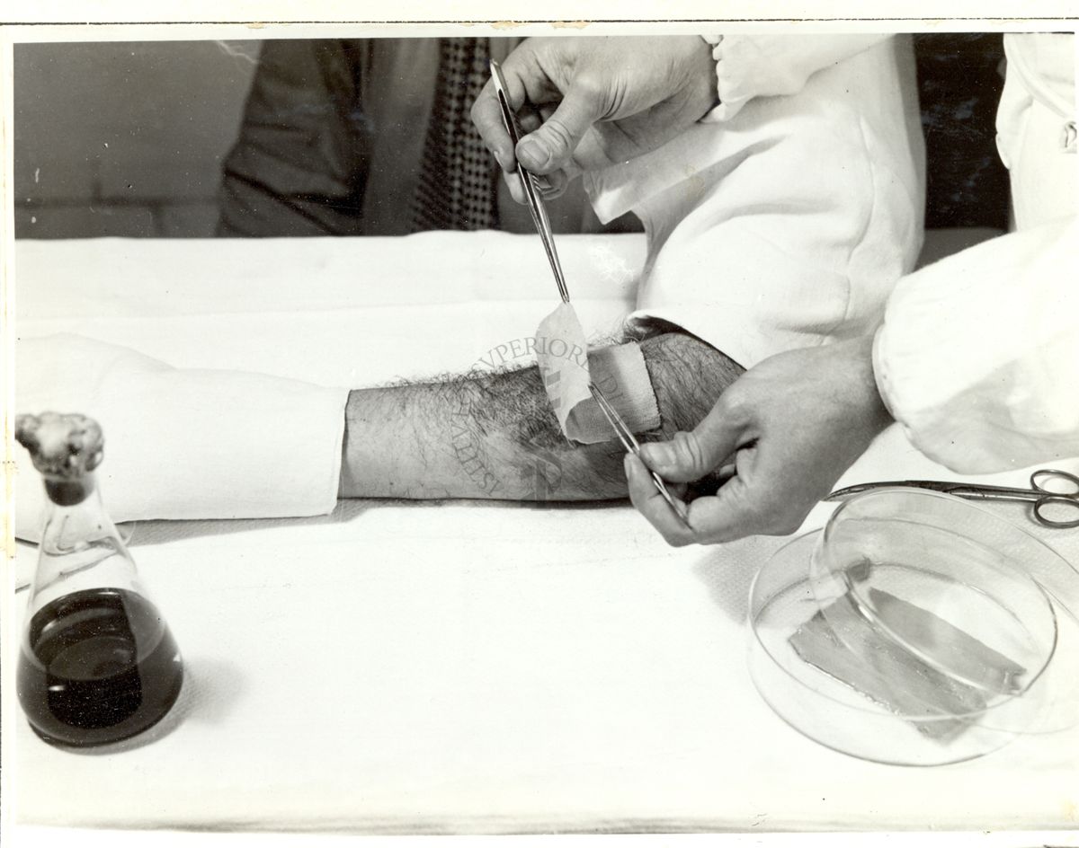 Tecnica di medicatura con Penicillina - b) applicazione di garza con Penicillina