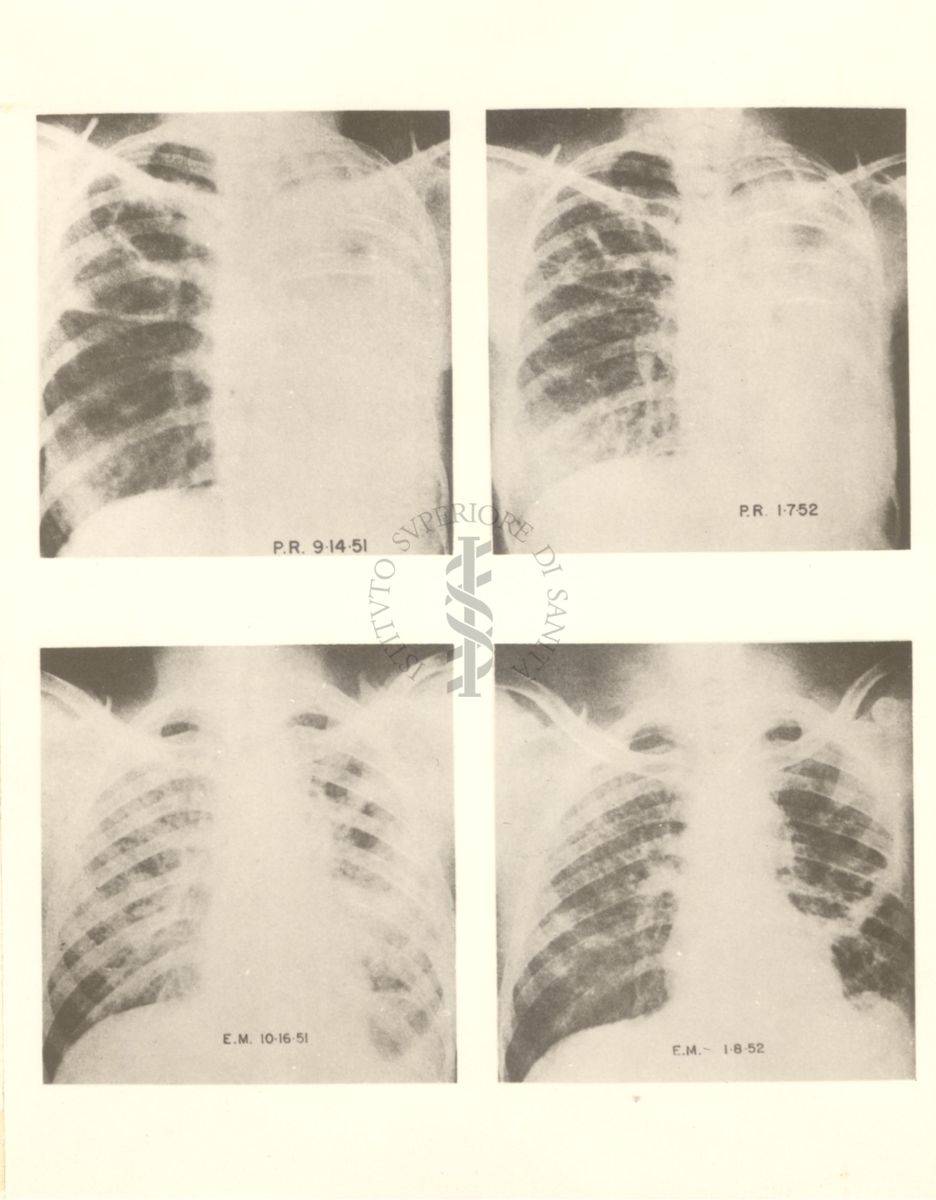 4 radiografie della gabbia toracica riguardanti l'azione dell'idrazide nella tubercolosi