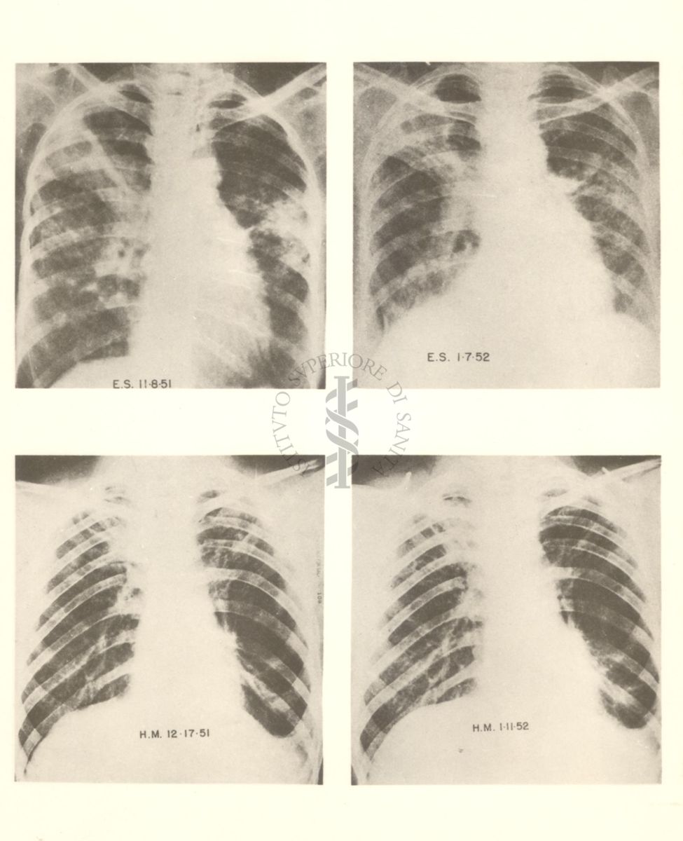 4 radiografie della gabbia toracica riguardanti l'azione dell'idrazide nella tubercolosi