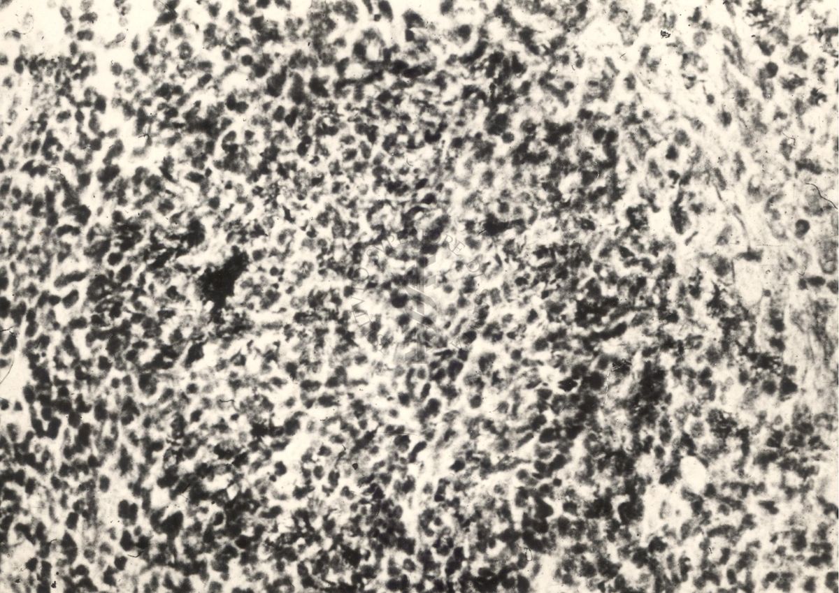 Sezione istologica di rene di topino inoculato con Mycobacterium minetti. Piccolo focolaio flogistico, in cui si vedono molti micobatteri