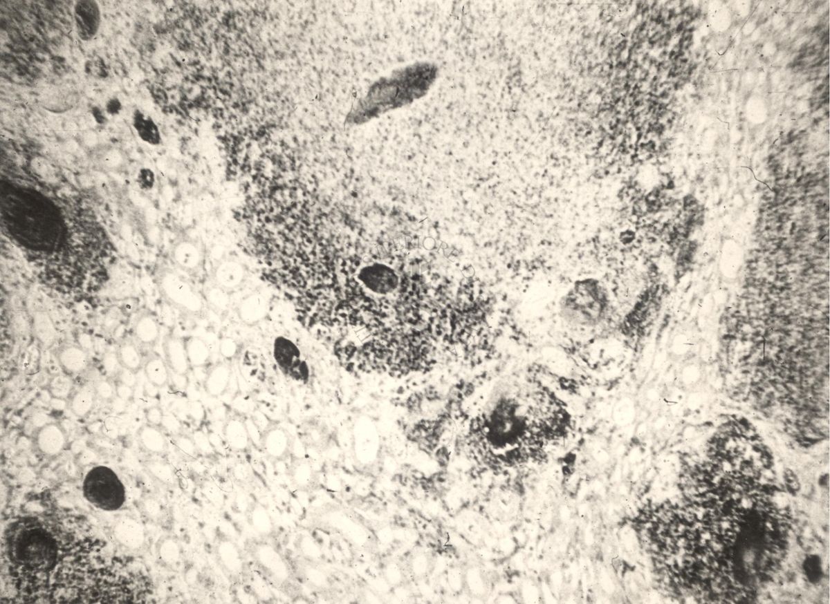 Sezione istologica di rene di topino inoculato con Mycobacterium minetti. I micobatteri si trovano nei focolai di flogosi e nei tubuli ad essi adiacenti