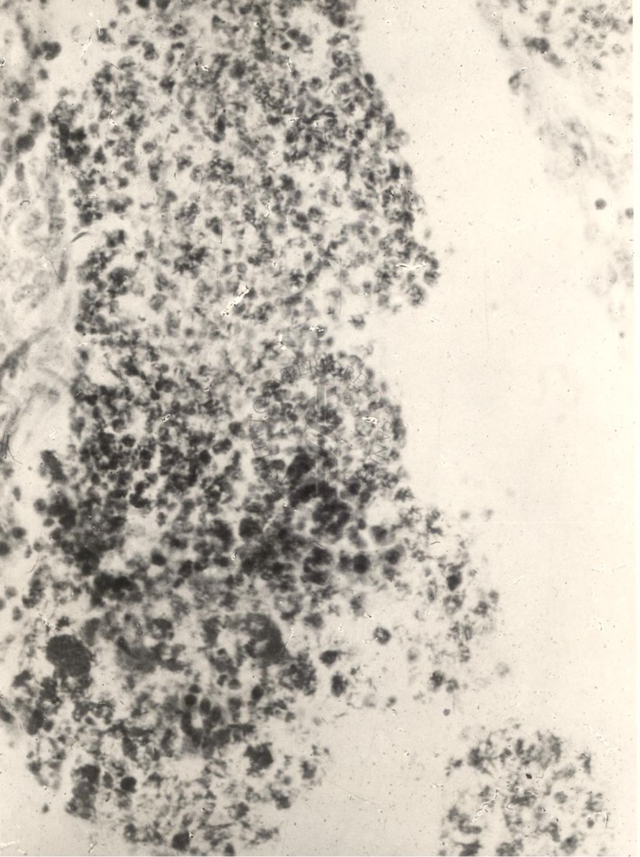 Sezione istologica di rene di topino inoculato con Mycobacterium minetti. Cellule flogistiche e micobatteri nel bacinetto
