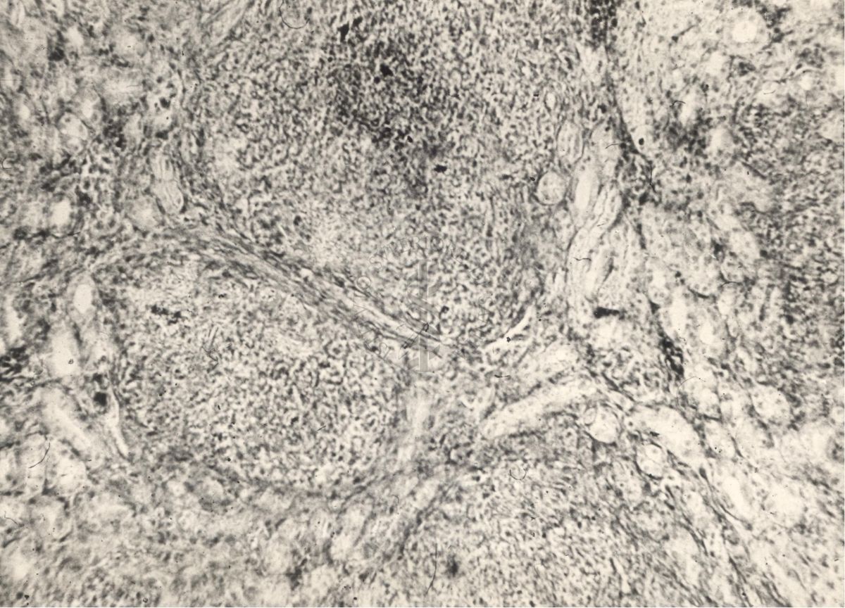 Sezione istologica di rene di cavia inoculata con Mycobacterium minetti. Focolai flogistici con capsule ben delimitate e micobatteri nei focolai