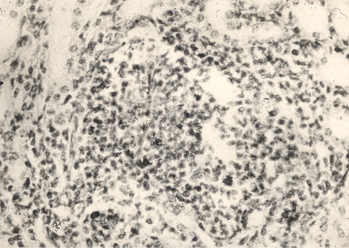 Sezione istologica di rene di cavia inoculata con Mycobacterium minetti. Micobatteri in un piccolo focolaio flogistico