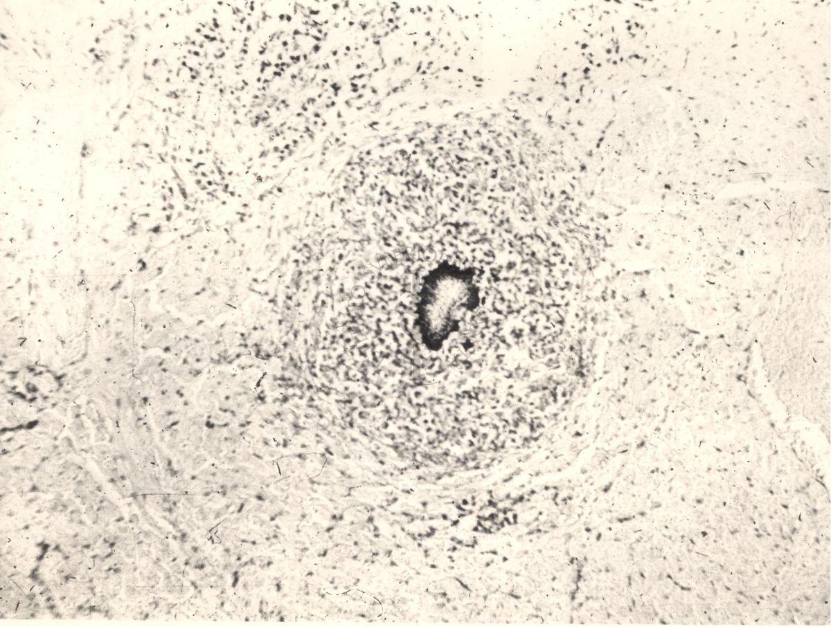 Sezione istologica di cuore di cavia inoculata con Mycobacterium minetti. Focolaio flogistico nel miocardio con numerosi micobatteri