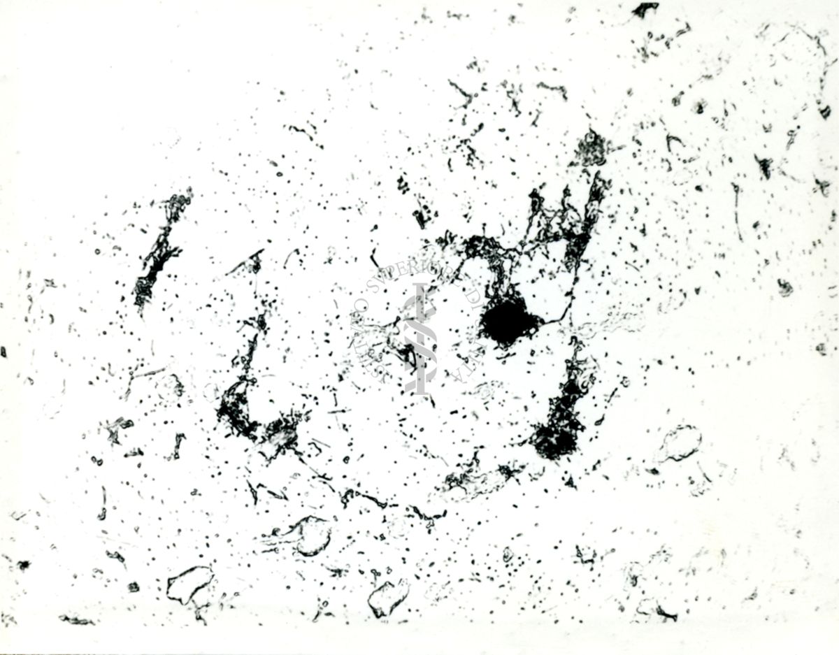 Striscio di secreto tracheale di soggetto tubercolotico