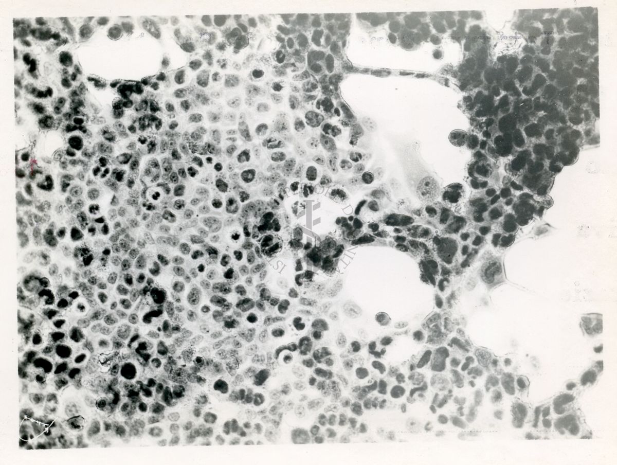 Cellule Hela infettate con virus APC di tipo 8 Col. E.E.