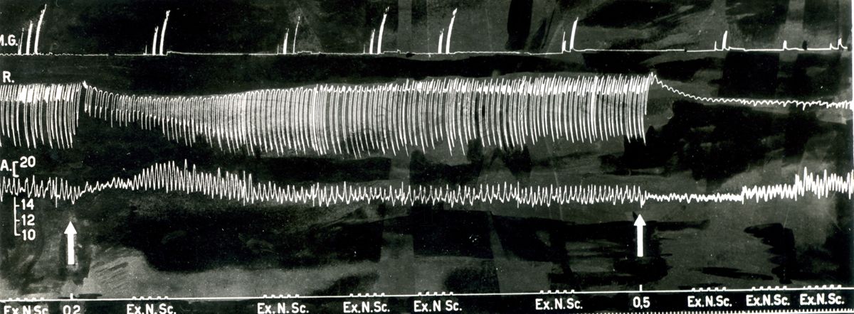 Tracciato dell'Azione curarizzante del trioduro del tri (trietilammonioetossi) 1,2,3 benzen (2559 F.). Effetto sulla trasmissione neuromuscolare, i movimenti respiratori e la pressione arteriosa del cane