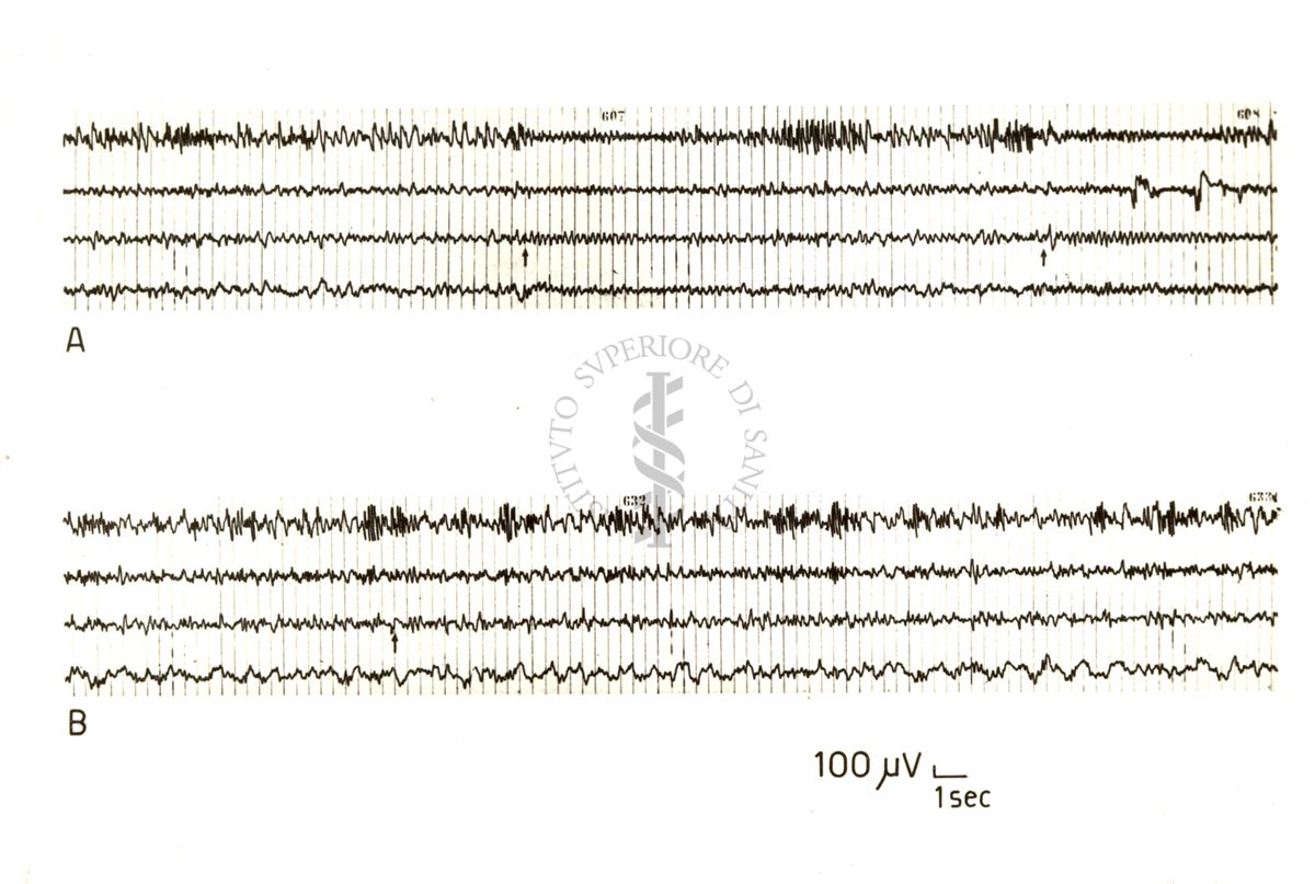 Ganglioplegici di sintesi - EEG nel coniglio (reazione d'arresto) prima e dopo Parsidol (Von Berger e Longo)