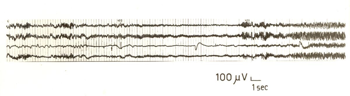 Ganglioplegici di sintesi - EEG nel coniglio azione della nicotina (Von Berger e Longo)