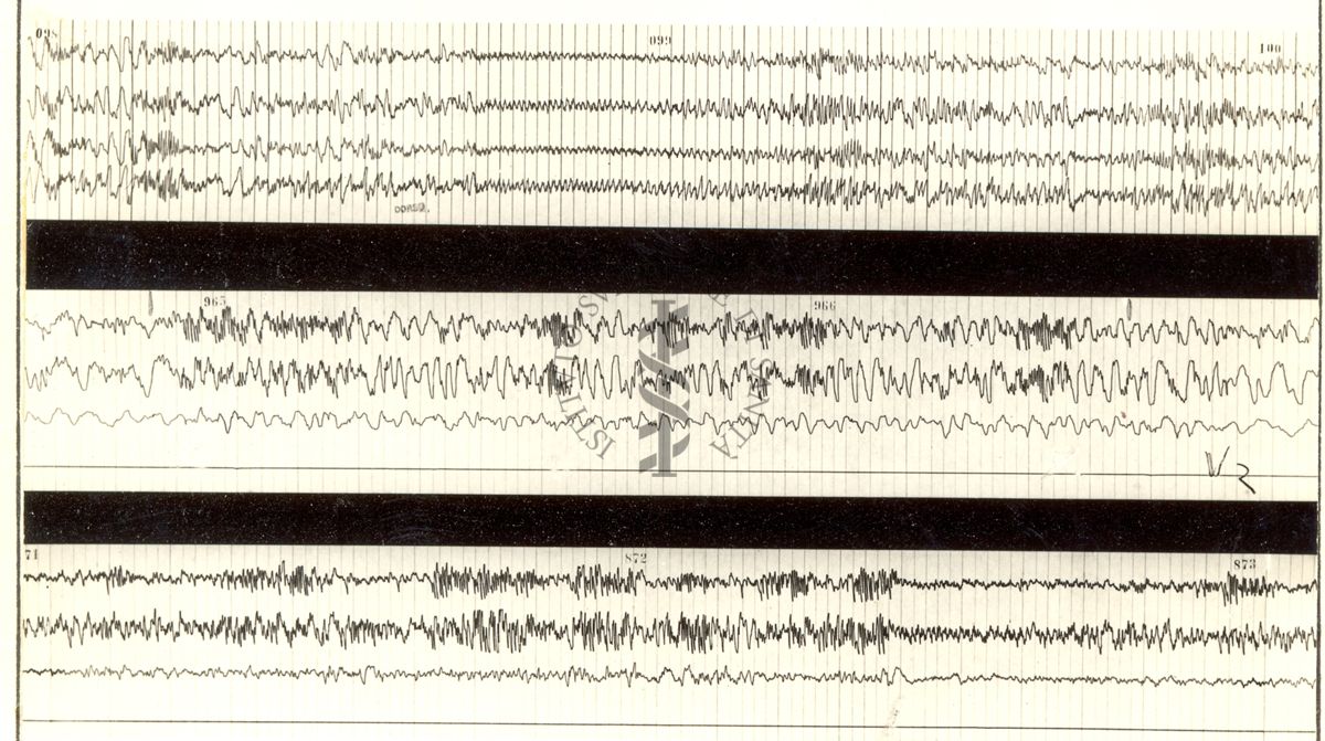 Tracciati elettroencefalografici