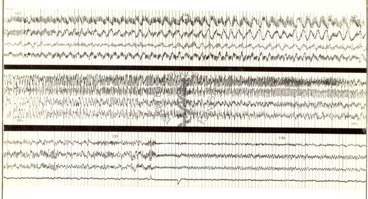 Tracciati elettroencefalografici