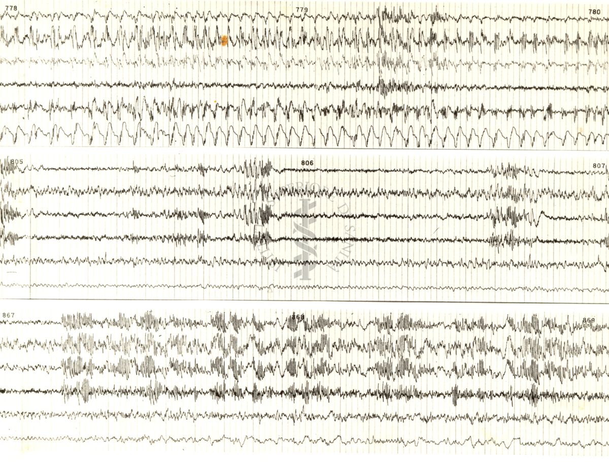 Tracciati elettroencefalografici