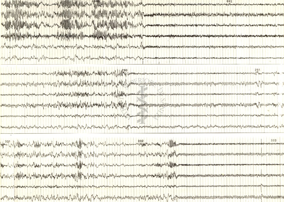 Tracciati elettroencefalografici