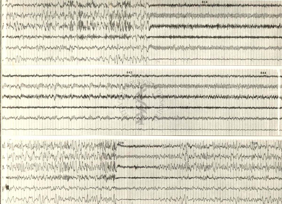 Tracciati elettroencefalografici