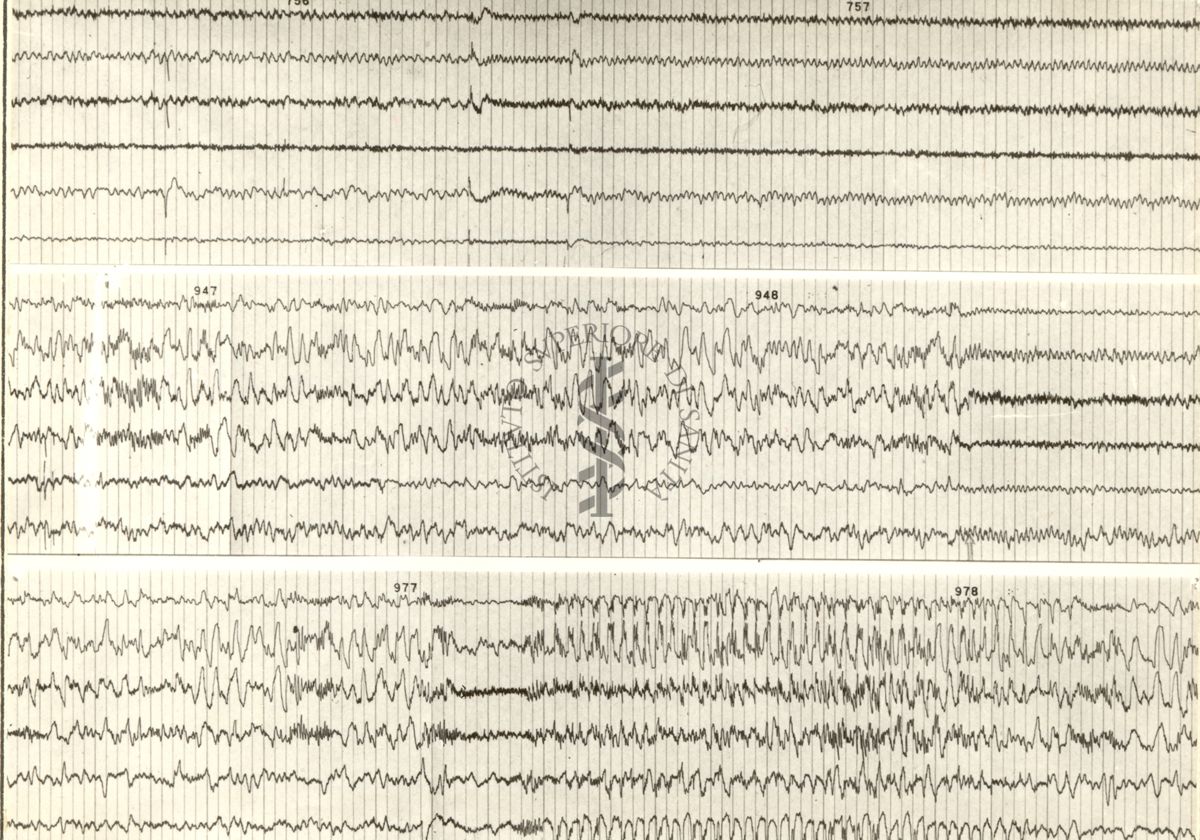 Tracciati elettroencefalografici