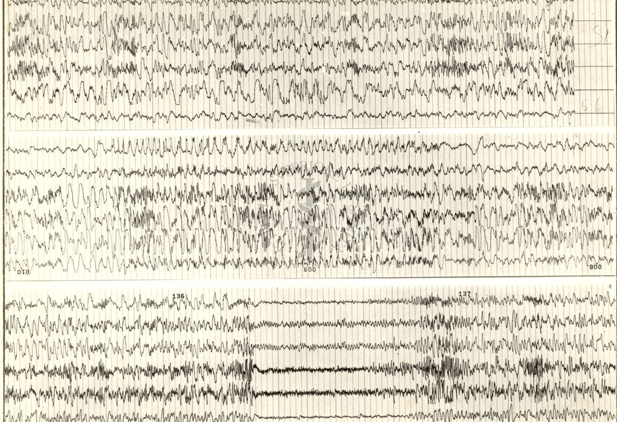 Tracciati elettroencefalografici