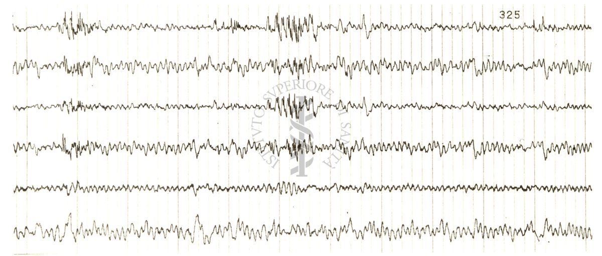 Tracciati elettroencefalografici