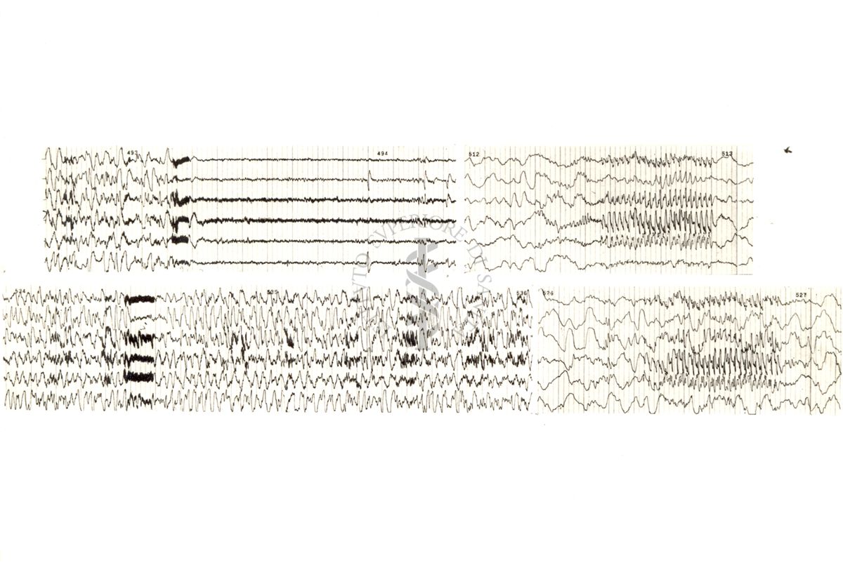 Tracciati elettroencefalografici