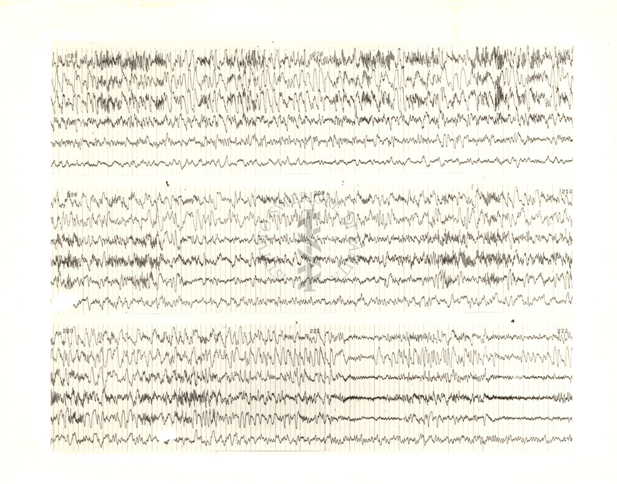 Tracciati elettroencefalografici